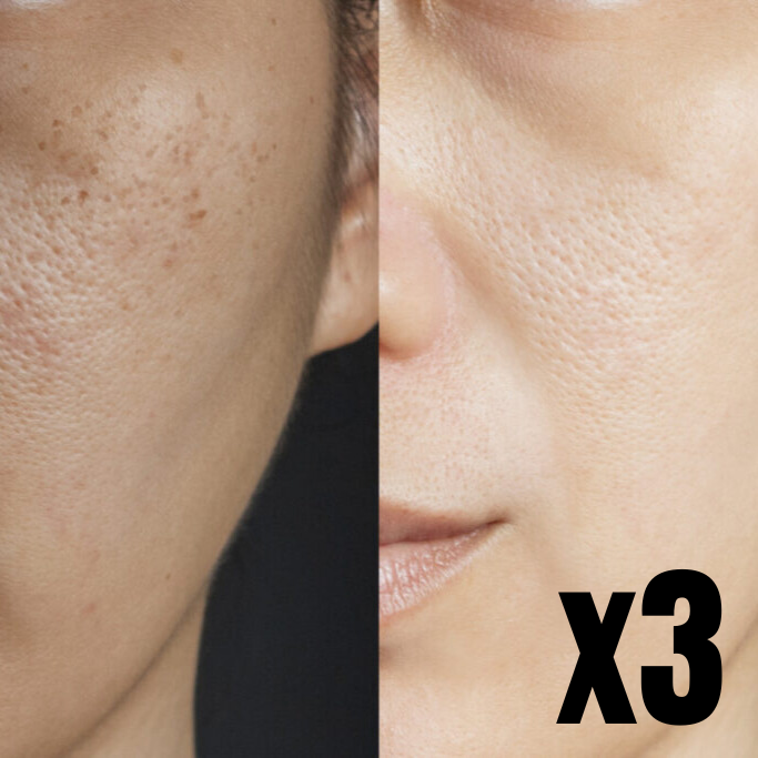 Chemical Peel - 3 Treatments